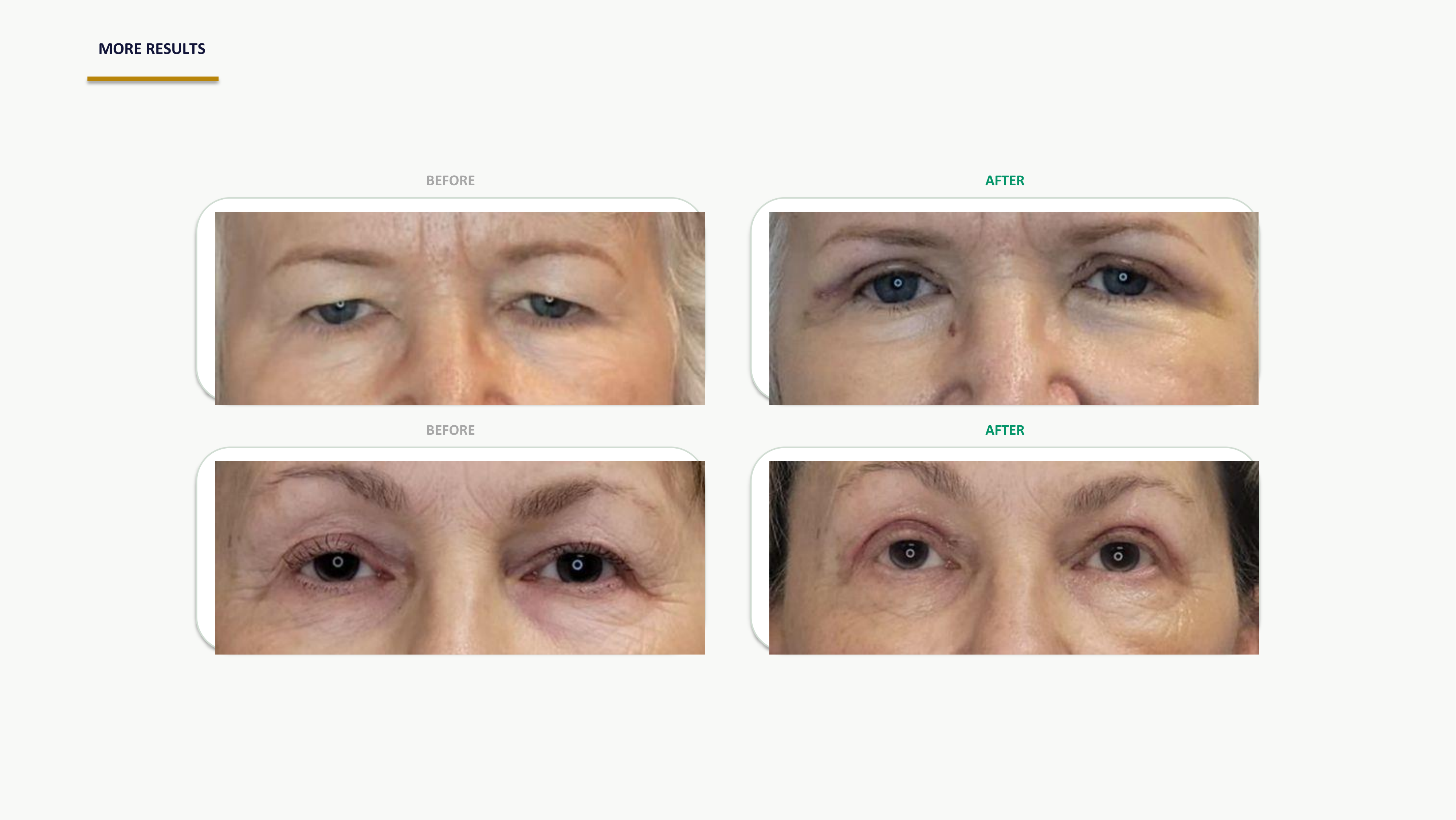 Ziplyft slide 2 — The Problem With Traditional Eyelid Surgery