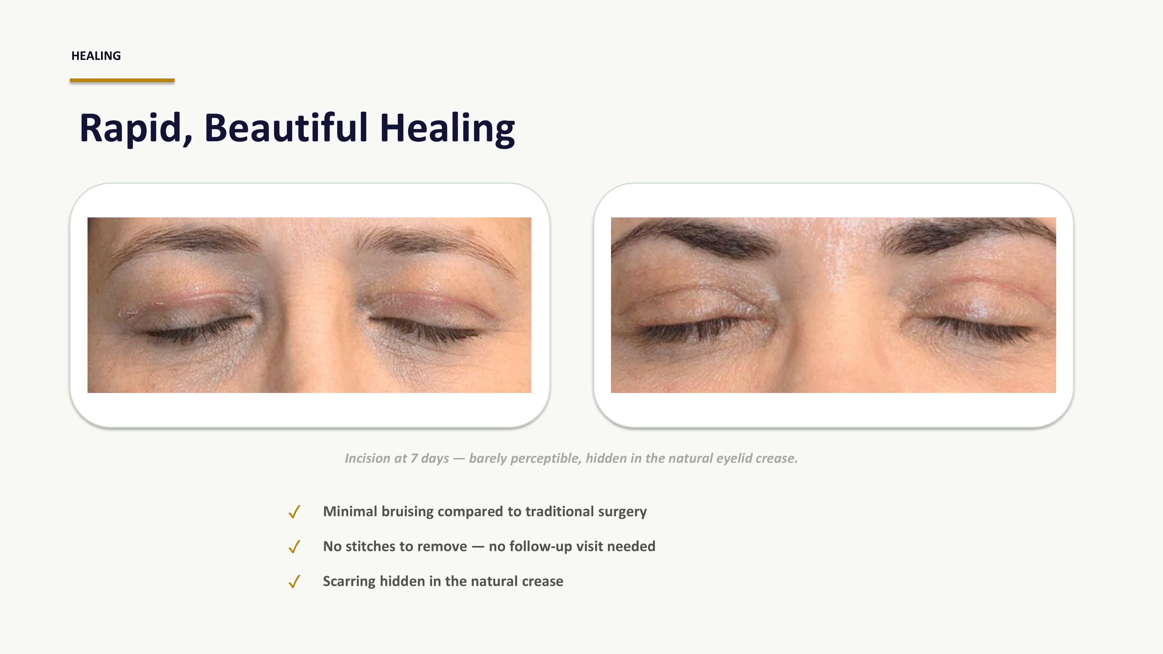 Ziplyft slide 7 — Why Patients Choose Ziplyft